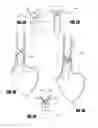 Fig. 07 - METHODS AND DEVICES FOR INTRAGASTRIC SUPPORT OF FUNCTIONAL OR PROSTHETIC GASTROINTESTINAL DEVICES