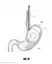 Fig. 35 - METHODS AND DEVICES FOR INTRAGASTRIC SUPPORT OF FUNCTIONAL OR PROSTHETIC GASTROINTESTINAL DEVICES