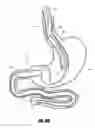 Fig. 45 - METHODS AND DEVICES FOR INTRAGASTRIC SUPPORT OF FUNCTIONAL OR PROSTHETIC GASTROINTESTINAL DEVICES