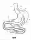 Fig. 49 - METHODS AND DEVICES FOR INTRAGASTRIC SUPPORT OF FUNCTIONAL OR PROSTHETIC GASTROINTESTINAL DEVICES