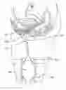 Fig. 01 - Female catheter