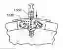 Fig. 01 - Joint arthroplasty devices and surgical tools
