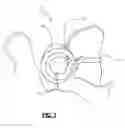 Fig. 02 - Methods and Apparatus for Treating Spinal Stenosis