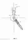 Fig. 06 - HINGED BONE SCREW WITH A TULIP BULB CONNECTOR IN A SPINAL FIXATION ASSEMBLY