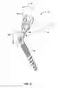 Fig. 07 - HINGED BONE SCREW WITH A TULIP BULB CONNECTOR IN A SPINAL FIXATION ASSEMBLY