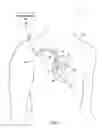 Fig. 02 - Non-sustained tachyarrhythmia analysis to identify lead related condition