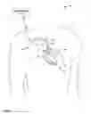 Fig. 02 - PHRENIC NERVE STIMULATION DETECTION USING HEART SOUNDS
