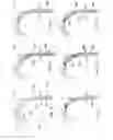 Fig. 08 - Methods of implanting a prosthesis