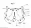 Fig. 07 - Encapsulated heart valve
