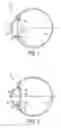 Fig. 02 - METHOD FOR DESIGNING, EVALUATING AND OPTIMIZING OPHTHALMIC LENSES AND LASER VISION CORRECTION