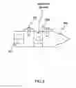 Fig. 04 - Advanced intra-spinal decompression implant