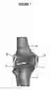 Fig. 02 - KNEE PROSTHESIS