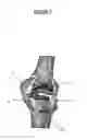 Fig. 04 - KNEE PROSTHESIS