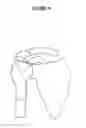Fig. 22 - KNEE PROSTHESIS
