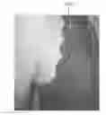 Fig. 01 - Breast shaping adhesive and methods for shaping breasts