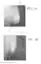 Fig. 02 - Breast shaping adhesive and methods for shaping breasts