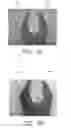 Fig. 04 - Breast shaping adhesive and methods for shaping breasts