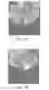 Fig. 05 - Breast shaping adhesive and methods for shaping breasts