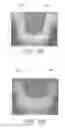 Fig. 06 - Breast shaping adhesive and methods for shaping breasts
