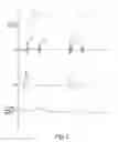 Fig. 02 - Pulse detection apparatus, software, and methods using patient physiological signals
