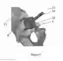 Fig. 08 - Guiding instruments and impactors for an acetabular cup implant, combinations thereof, methods for manufacturing and uses thereof