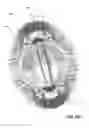 Fig. 12 - Magnetic Shoe Insert System