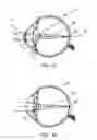Fig. 02 - Diffractive lens exhibiting enhanced optical performance