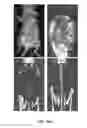 Fig. 02 - BRIEF RADIOIMMUNOTHERAPY
