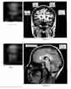 Fig. 07 - Transcranial magnet stimulation of deep brain targets