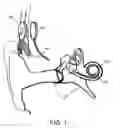 Fig. 02 - Cochlear implant with improved electrode array and controller