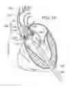 Fig. 09 - System and method for treating valve insufficiency or vessel dilatation