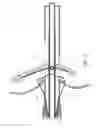 Fig. 11 - Methods and apparatus for atrioventricular valve repair