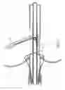 Fig. 12 - Methods and apparatus for atrioventricular valve repair