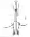 Fig. 13 - Methods and apparatus for atrioventricular valve repair
