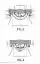 Fig. 02 - Accommodative intraocular lens driven by ciliary mass