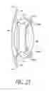 Fig. 22 - Intraocular lens