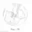 Fig. 19 - BONE GRAFTS