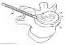 Fig. 01 - In-situ intervertebral fusion device and method
