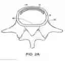 Fig. 03 - In-situ intervertebral fusion device and method
