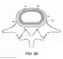 Fig. 04 - In-situ intervertebral fusion device and method