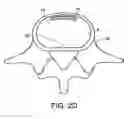 Fig. 06 - In-situ intervertebral fusion device and method
