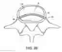 Fig. 07 - In-situ intervertebral fusion device and method