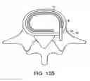 Fig. 22 - In-situ intervertebral fusion device and method