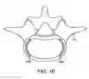 Fig. 28 - In-situ intervertebral fusion device and method