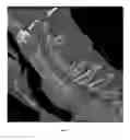 Fig. 02 - ORTHOTIC BONE STIMULATOR