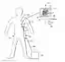 Fig. 01 - Method and devices for treating atrial fibrillation by mass ablation