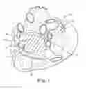 Fig. 02 - Method and devices for treating atrial fibrillation by mass ablation