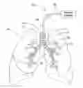 Fig. 01 - SYSTEMS, ASSEMBLIES, AND METHODS FOR TREATING A BRONCHIAL TREE