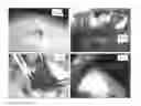 Fig. 07 - Method of hernia repair using surgical mesh
