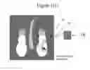 Fig. 04 - Mitigation of pressure ulcers using electrical stimulation